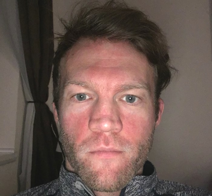 Rosacea Flare Up on Face