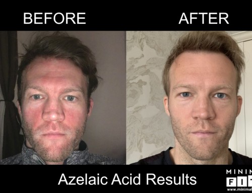 How I Cured Rosacea Using Azelaic Acid (Before & After Pics)